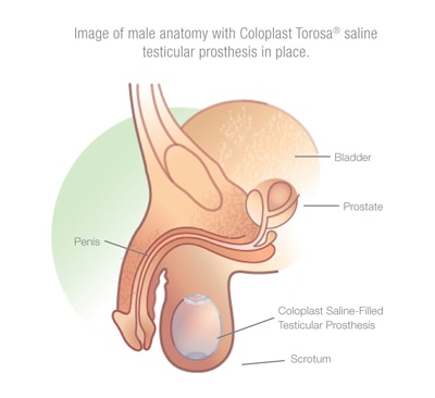 testicular prosthesis