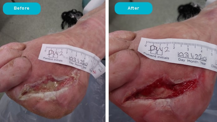 Diabetic Foot Ulcer cleansed and debrided with Alprep Pad