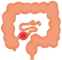 End ileostomy End ileostomy