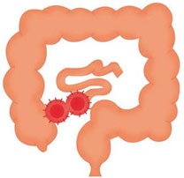 Loop ileostomy Loop ileostomy