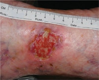 The ulcer at inclusion after cleansing.