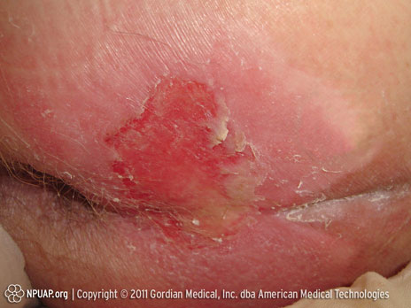 Pressure ulcer Category/Stage II: Partial thickness skin loss or blister 