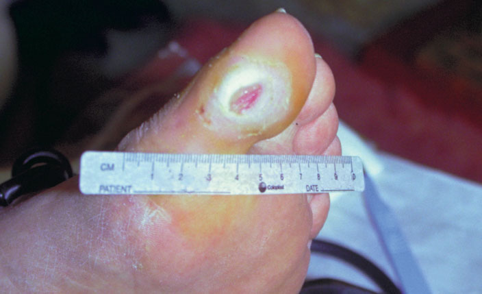 neurophatic foot ulcer