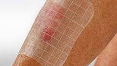 Wound monitoring