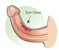 penis scar tissue