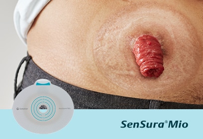 Is your stoma on a regular area?