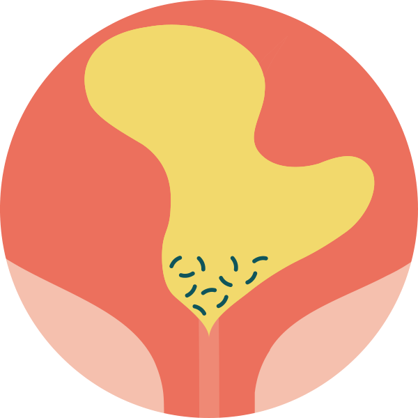 Illustration Luja conventional eyelets residual urine with bacteria