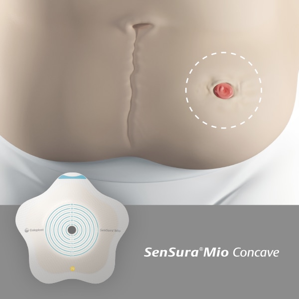 Is your stoma on an area with  bulges or curves? 