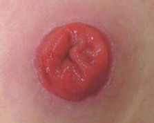 Clean healthy stoma