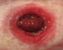 Red unhealthy stoma