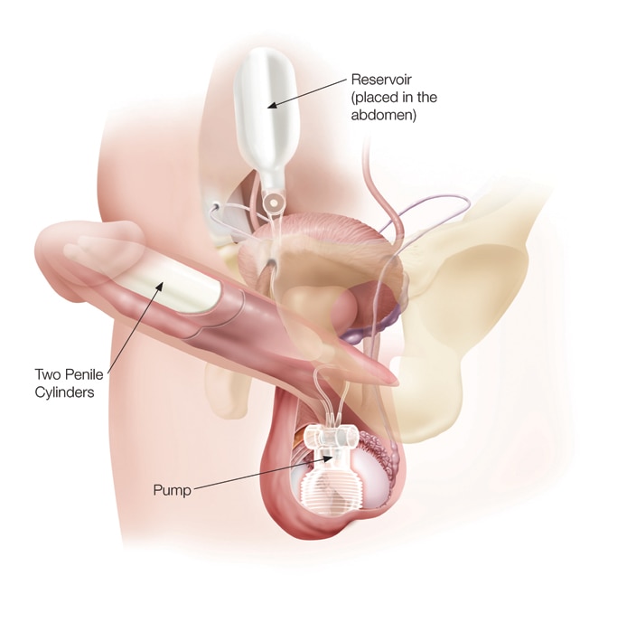 Titan - penile implant