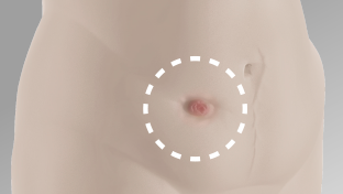 Inward area of stoma on abdomen