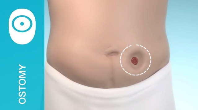 A properly fitting stoma bag with stoma adhesives is essential for