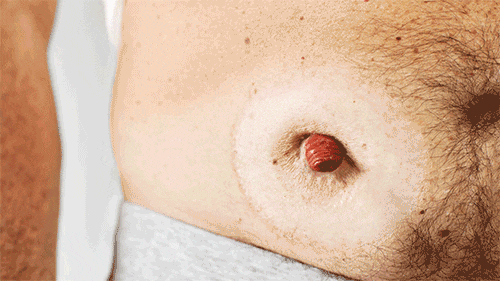stoma with convex ostomy bag